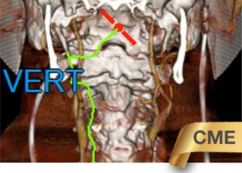 Right Vert Compression feature CME