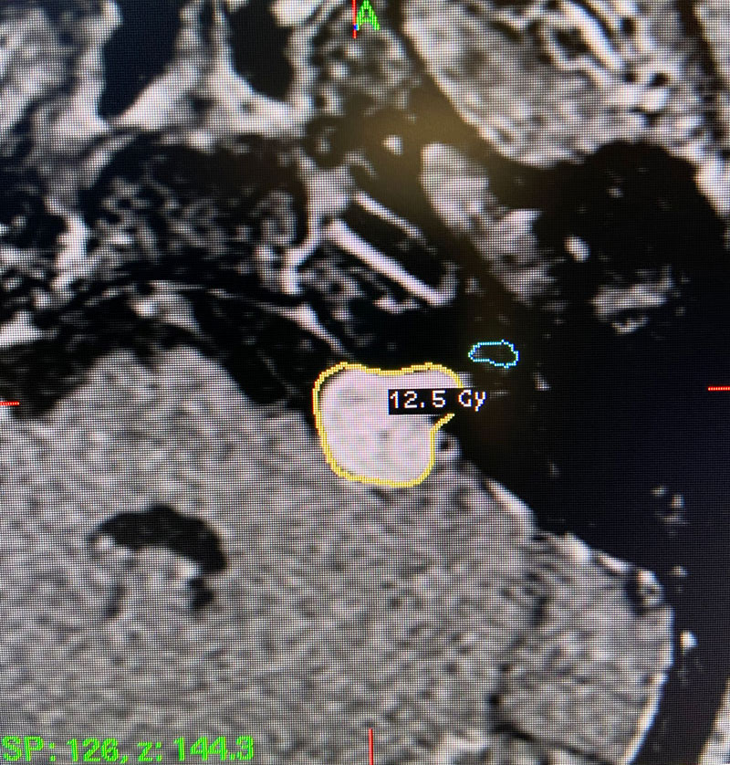 55 year old woman with one year of progressive hearing loss in the left ear / Acoustic Neuroma 2