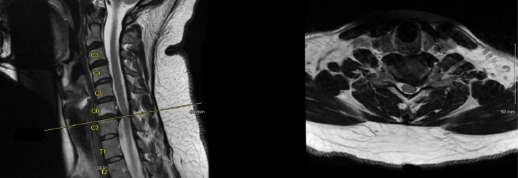 Fusionless Cervical Spine Surgery for Herniated Disc 1