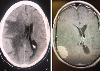 Atypical Convexity Meningioma featured