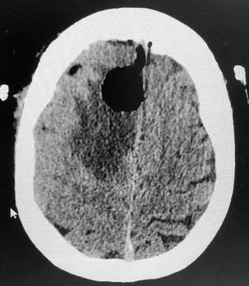 Post operative CT scan