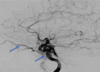 Carotid Cavernous Fistula feature