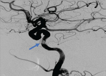 Carotid Cavernous Fistula CCF featured