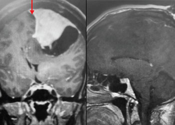 Cycstic Meningioma Feature