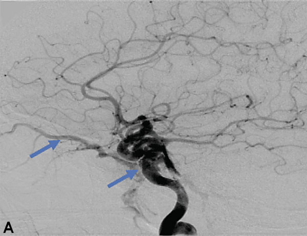 Carotid Cavernous Fistula (CCF) 1