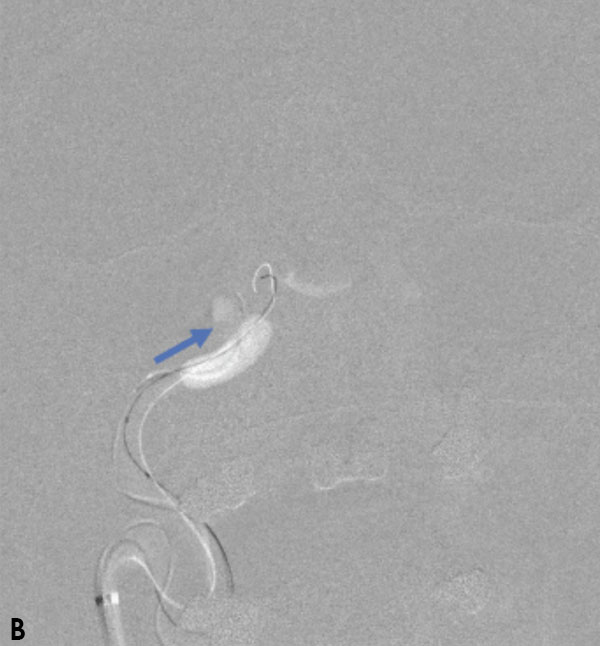 Carotid Cavernous Fistula (CCF) 2