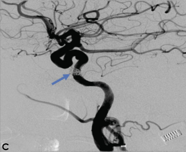 Carotid Cavernous Fistula (CCF) 3