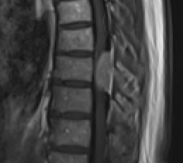 Preoperative MRI T1w demonstrating a large enhancing tumor with severe cord compression