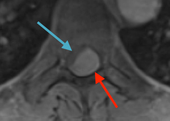 Gaudin Spine meningioma feature