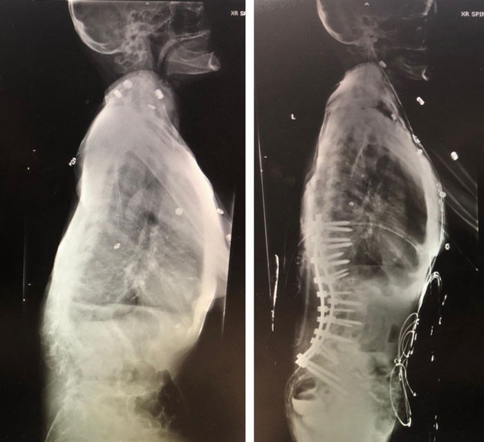 Surgical Correction of Thoracolumbar Kyphoscoliosis Deformity