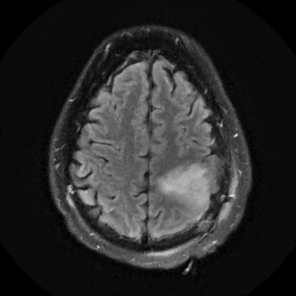 Grade II Oligodendroglioma 1