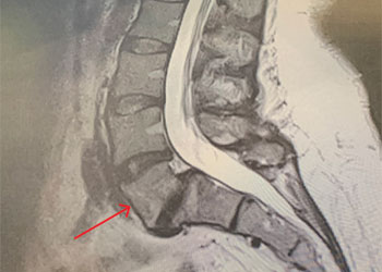 Laminectomy Back Pain Feature