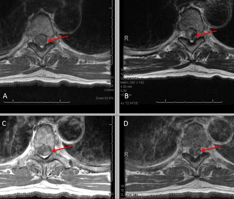 A) T1 B) C+ T1 C) STIR D) FS C+ T1 demonstrate focal hemorrhage, contrast enhancement, mass effect, and myelopathic cord signal at T4 (arrows)