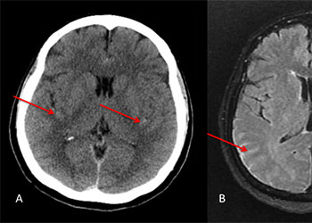 Rupt Thor Spinal Arterial feature