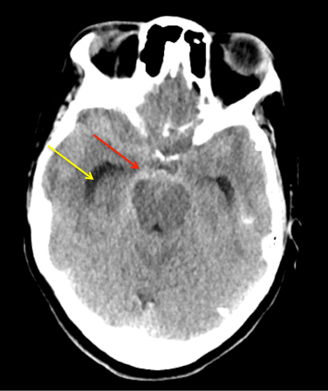 Man in 40’s with progressive confusion and headaches 1