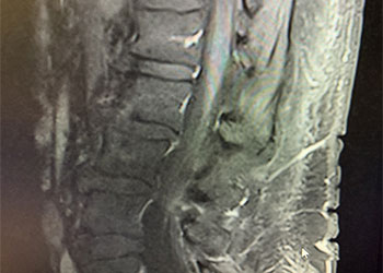 Spinal Dural Fistula feature