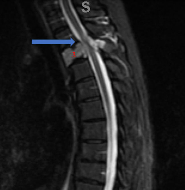 Spinal Embolization Treats Aggressive Comprehensive T3 Verterbral Body Hemangioma 1