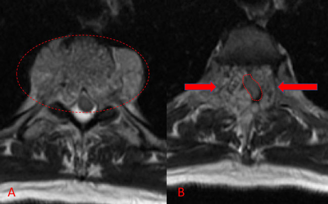 Spinal Embolization Treats Aggressive Comprehensive T3 Verterbral Body Hemangioma 2