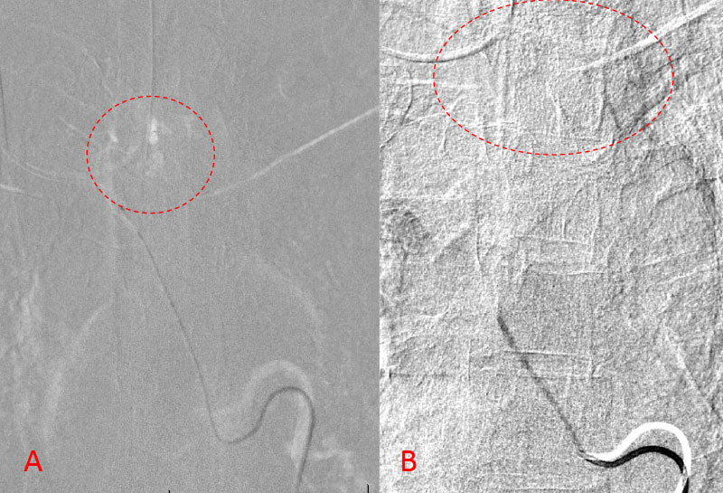 demonstrates selective PVA embolization with complete devascularization of the tumor on completed embolization