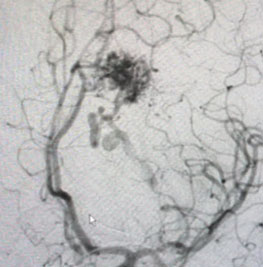 25 year old woman with Brain AVM (arteriovenous malformation) 3