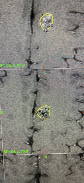 25 year old woman with Brain AVM (arteriovenous malformation) 5