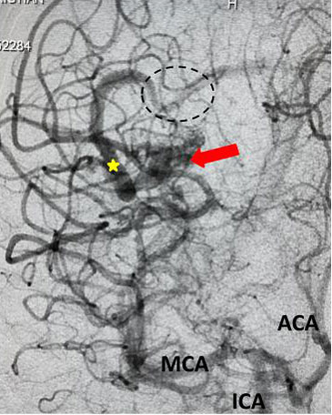 Young college student with severe headache and a large intracerebral bleed 2