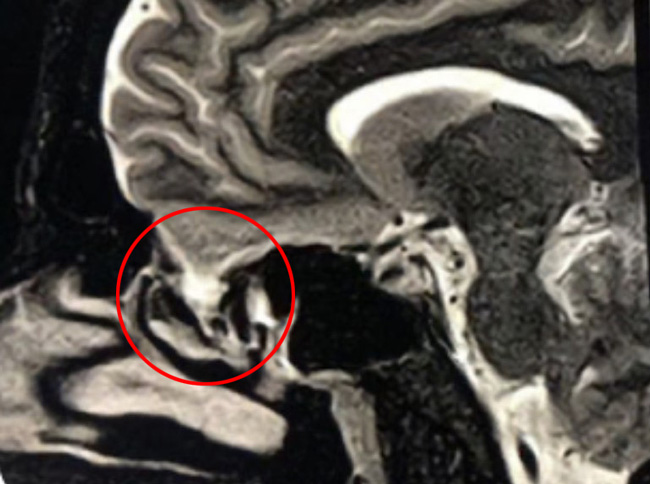 Sagittal T2 MRI