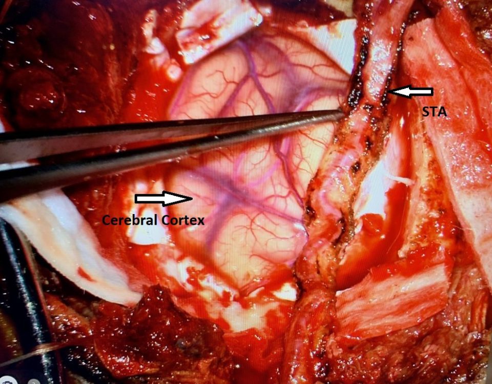 Dr. J. Brisman EDAS Case Summary Fig. 3 Image At Treatment Completed Right Sided EDAS Procedurefinal 2