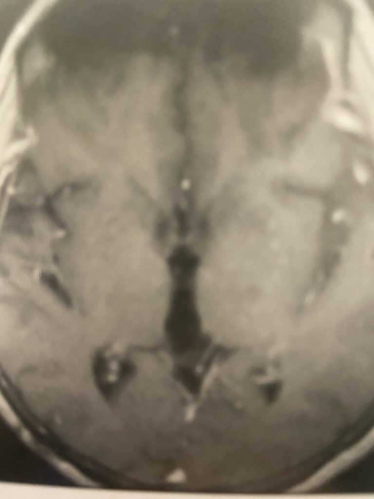 Pineal Region Meningioma 5