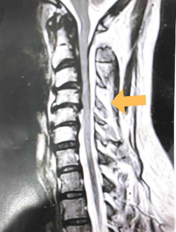 Hyperintense signal (arrow) at the C3-4 interspinous space consistent with ruptured interspinous ligament,C4-5