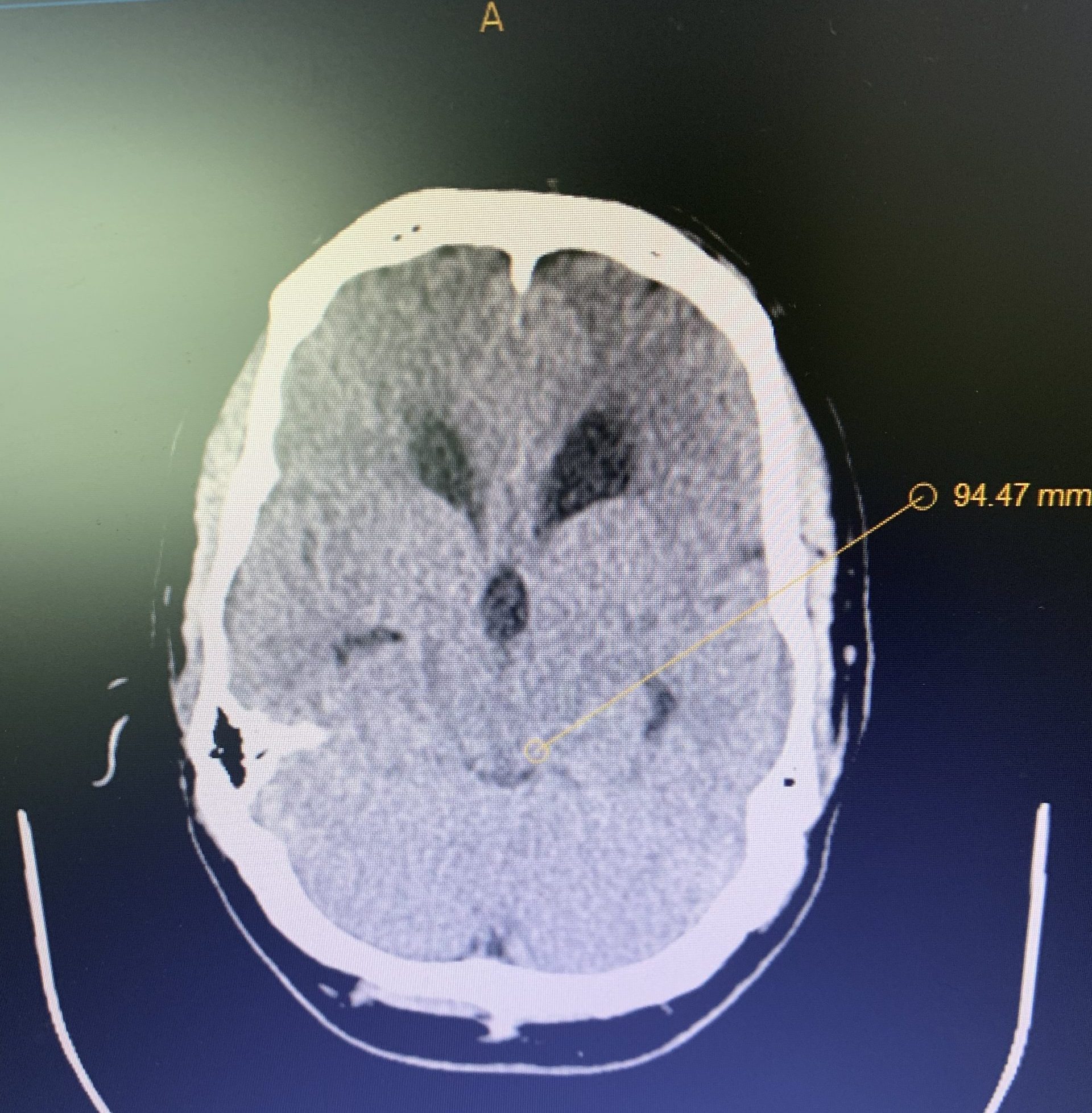 IMG 3734 JLB 2022 Brainstem Tumor EBlast Photo 2 scaled e1649447573169