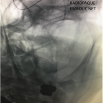 Unusual Indication for Carotid Stenting Over Endarterectomy 3