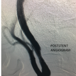 Unusual Indication for Carotid Stenting Over Endarterectomy 5