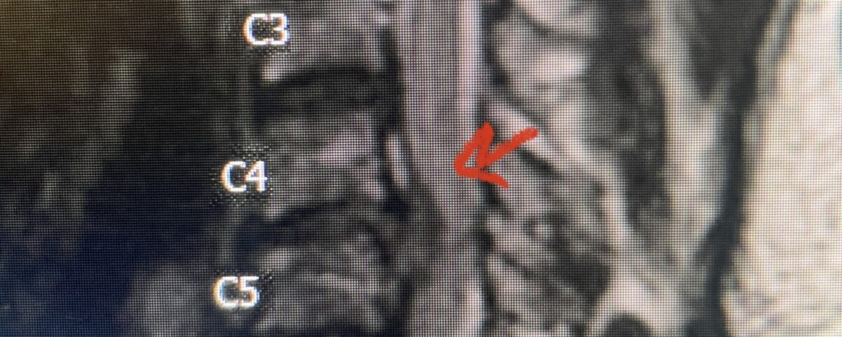 Fig 2a Sagittal and axial T2 weighted cervical MRIs demonstrating large C4 5 herniated disc with spinal cord compression red arrows