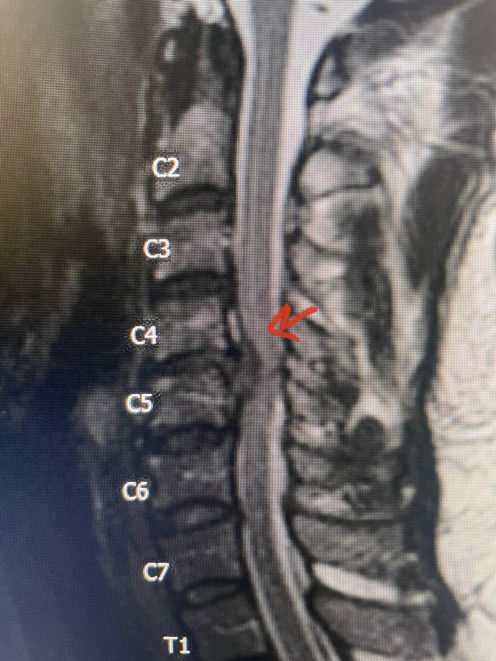 Fig 2a Sagittal and axial T2 weighted cervical MRIs demonstrating large C4 5 herniated disc with spinal cord compression red arrows