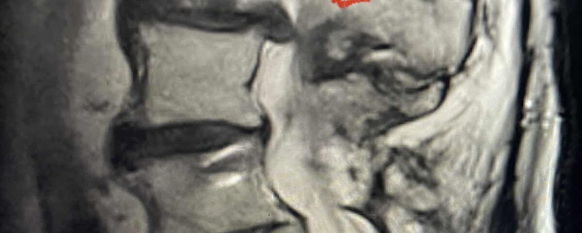 Fig 1 Sagittal and axial T2 weighted lumbar and 1B L4-S1 instrumented fusion