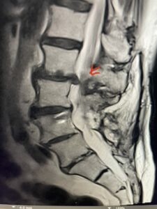 Fig 1A Sagittal and axial T2 weighted lumbar 