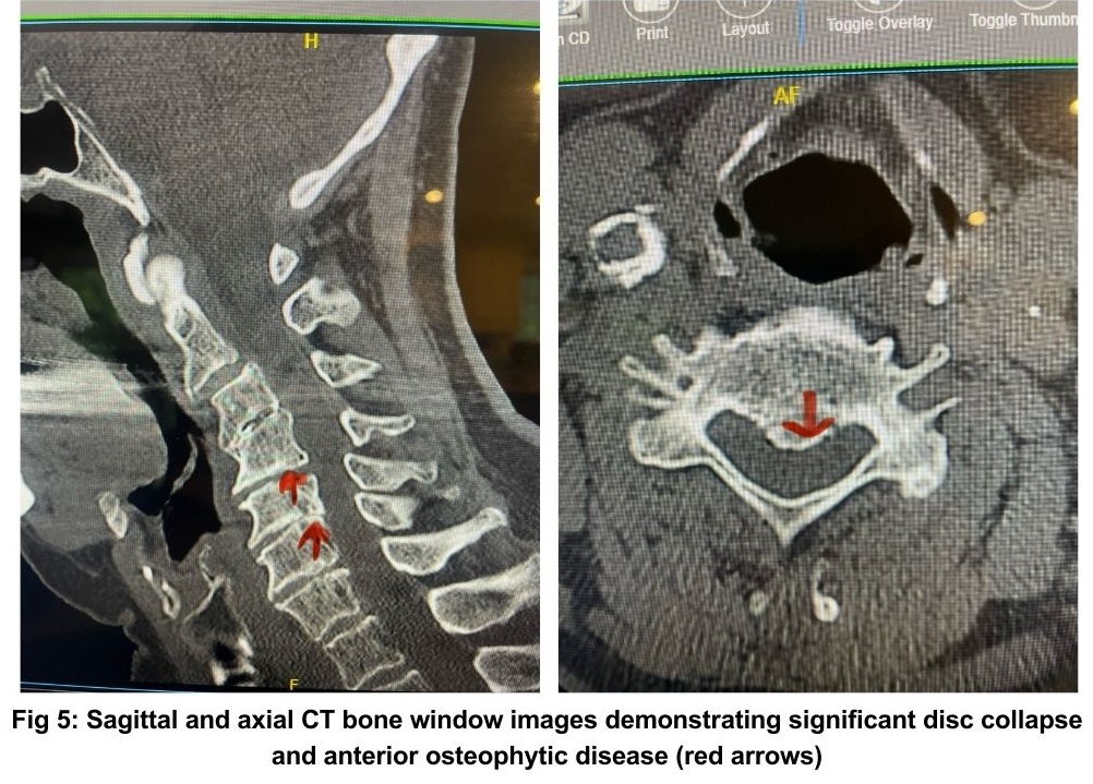 NSPC Brain & Spine Surgery fig 5